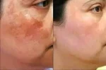 Angel Melasma Cream - Image 4
