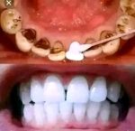 LANBENA Teeth Whitening Mousse - Image 3